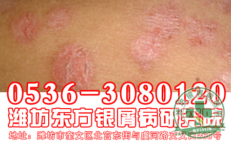 牛皮癣中医治疗不等于偏方治疗