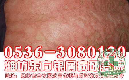 银屑病日常护理要点谁知道？