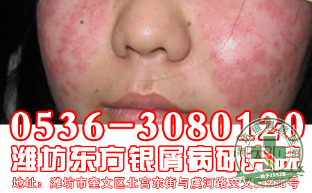 对于银屑病患者来讲，加强心理治疗非常重要！