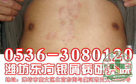 银屑病发病后禁用药物有哪些?【山东医院】