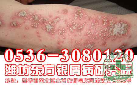 银屑病患者怎么做好唇部护理?