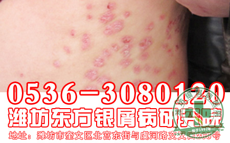 女性朋友为什么会得银屑病？