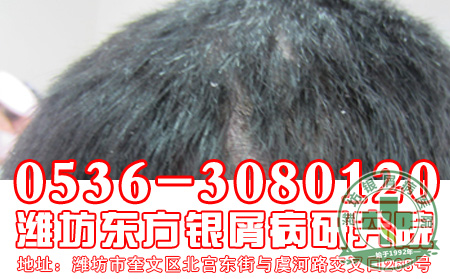 主任浅谈头皮银屑病护理常识