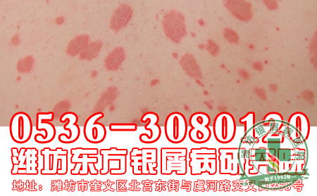 银屑病反复发作、久治不愈的原因是什么？【多