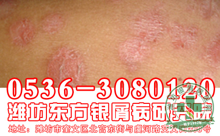 山药对银屑病患者有什么好处呢?
