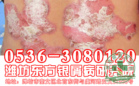 主任揭秘儿童银屑病的“幕后黑手”