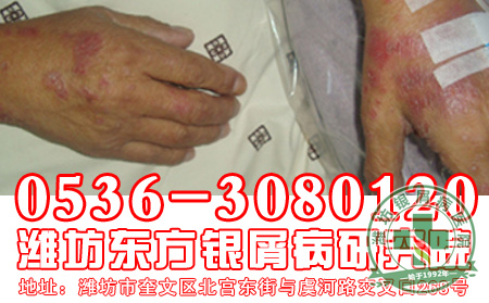 银屑病患者如何做好预防工作?