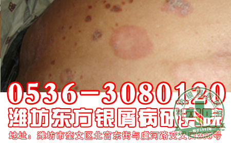 银屑病患者药物使用要注意什么问题?【今日关