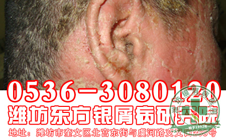 头部银屑病患者洗头注意哪些方面?