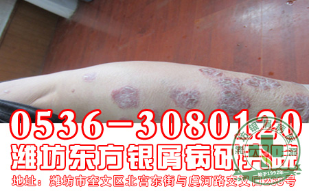 东方银屑病医院告诉大家对于银屑病的传染,患