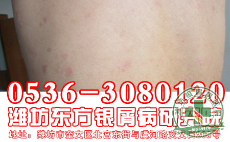 银屑病患者的日常护理应该注意什么问题?