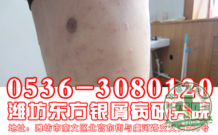 银屑病的治疗应该从哪些方面做起？