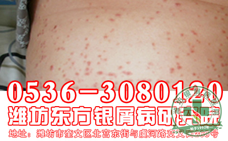 银屑病遗传几率会改变吗?【 治疗】