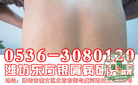 银屑病真的可以通过传染来发病?