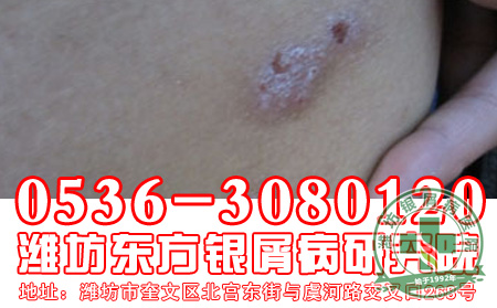 银屑病的预防工作要注意哪些方面？