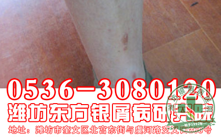 银屑病发病的周期是哪三个时期?