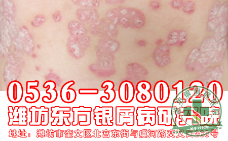 可乐对银屑病治疗有影响吗?
