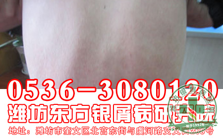 银屑病治疗怎么用药 好？