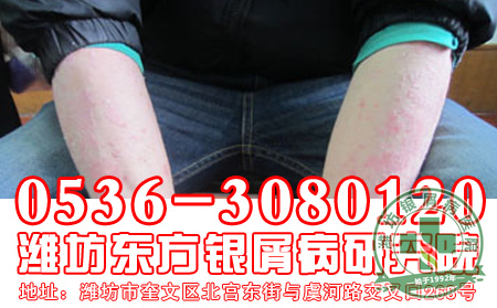 银屑病发病后怎样防止复发?