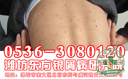 银屑病患者饮食应该注意怎么做?