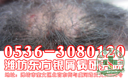 银屑病的治疗工作应该做到哪几点？