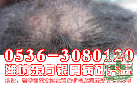 银屑病发病后会表现出的症状有什么？