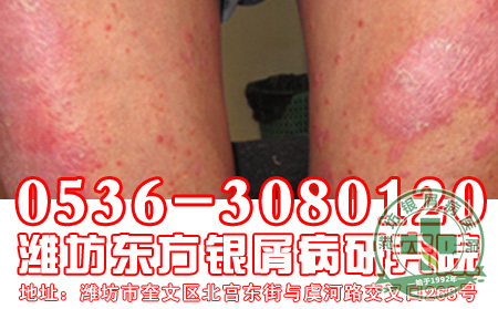 跑步对于银屑病治疗有什么好处?