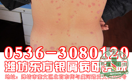 银屑病发病与患者的哪些因素有关？
