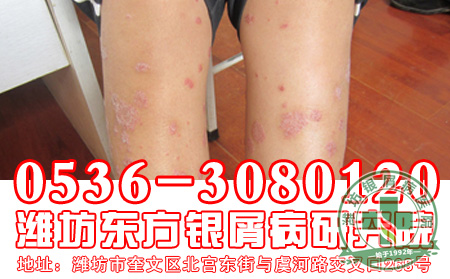 寻常型银屑病发病后患者会出现什么症状?