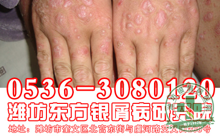 山东济南治疗银屑病专科医院手部银屑病怎么治