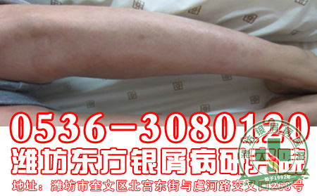 银屑病治疗使用的药物要注意什么?