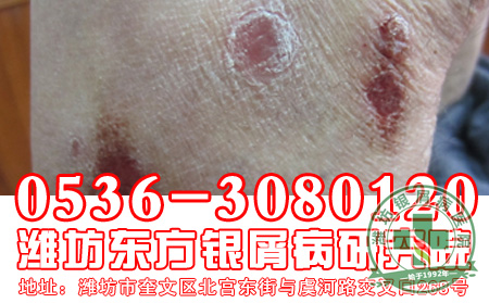 脓疱型银屑病的发病是怎样的?