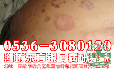 主任导读：银屑病是一种怎样的疾病？【牛皮癣