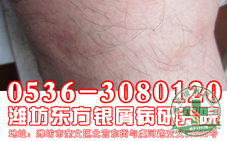 牛皮癣刚刚发病时的症状表现是怎样的?