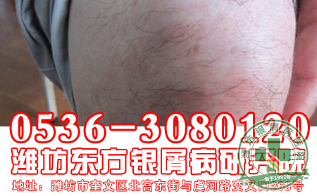 牛皮癣患者的日常生活中应该注意的问题有什么