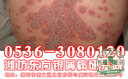为什么只靠偏方达不到治疗寻常型银屑病的效果