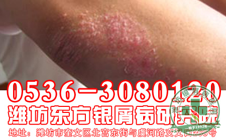 牛皮癣病情轻微需要治疗吗?