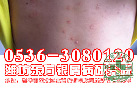 寻常型牛皮癣久治不愈的原因有什么?【平价医
