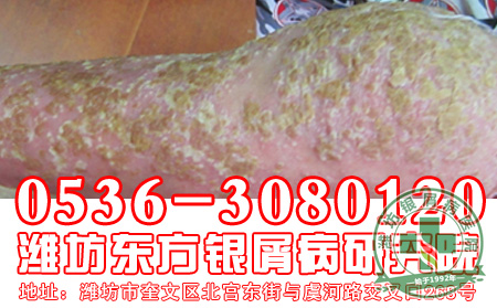 主任浅谈：银屑病扩散怎么办？