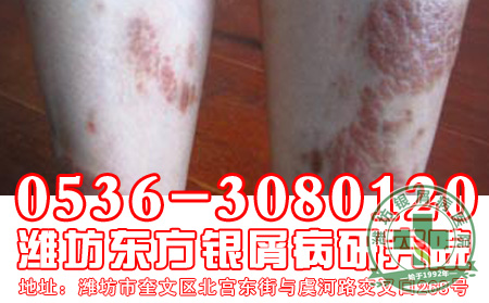 银屑病患者治疗后还有定期复诊的必要吗?
