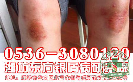 脓疱型银屑病护理的方法和研究【平价医院】