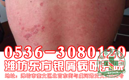 牛皮癣患者,你戒烟了吗