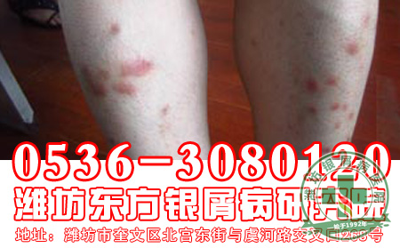 迎接春天预防牛皮癣