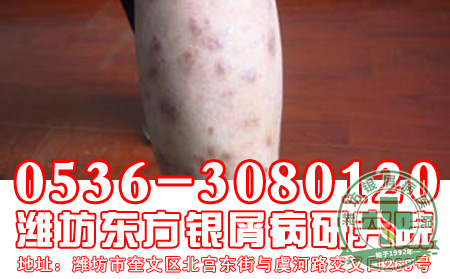 牛皮癣患者病发期可以洗海澡吗