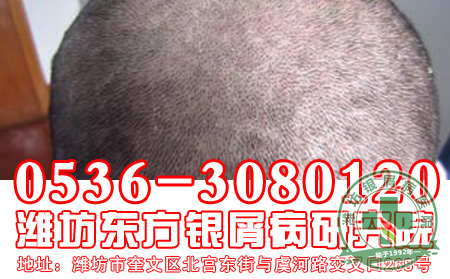 银屑病容易造成患者皮肤瘙痒出现吗？【定
