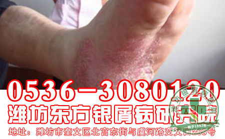 牛皮癣病员怎样保护下一代