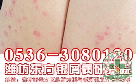 主任简述血热型银屑病症状表现
