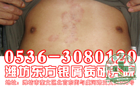 怎样祛除银屑病留
