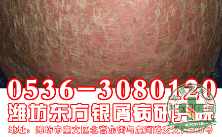 济南银屑病专科医院主任提醒：银屑病患者出游