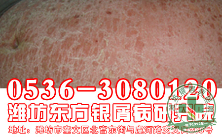 牛皮癣患者的病情怎样进行诊断?【 医院】